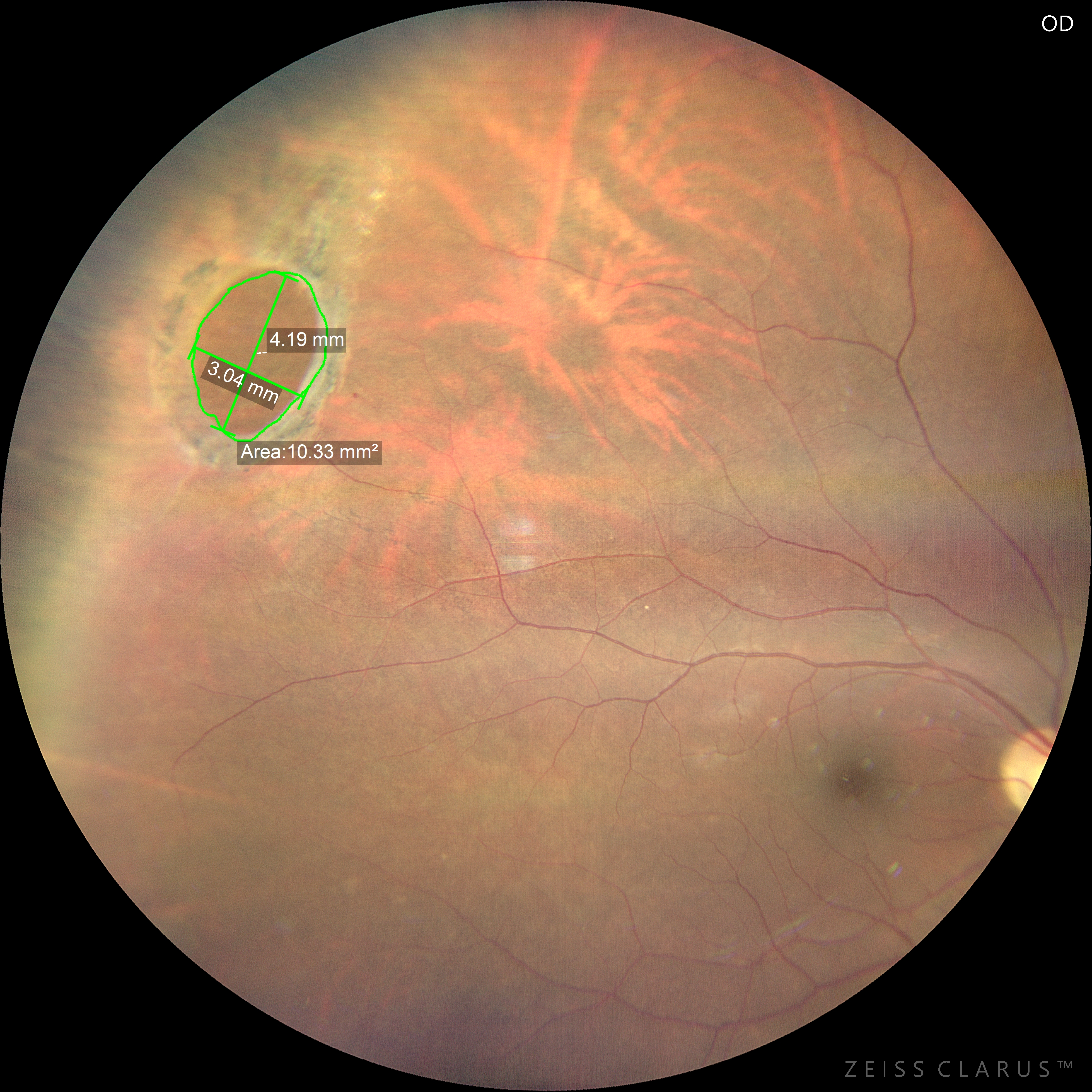 Incongruenze possibili nelle misure retiniche utilizzando Widefiel e Ultra Widefield Imaging